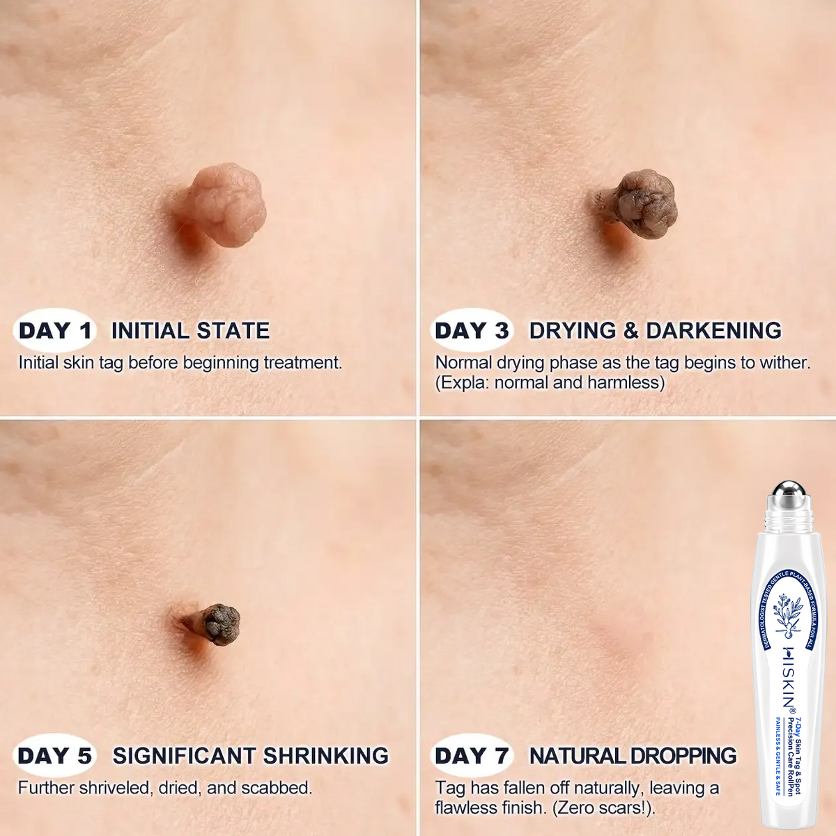❤️𝐇𝐈𝐒𝐊𝐈𝐍®👩‍⚕️ 𝟕-𝐃𝒂𝘆 𝐒𝗸𝐢𝐧 𝐓𝒂𝗴 & 𝐒𝐩𝙤𝐭 𝐄𝐫𝒂𝐬𝙚𝐫 Sans douleur & Scar-Free Advanced Imperfection Removal Rollerball Pen (副本)