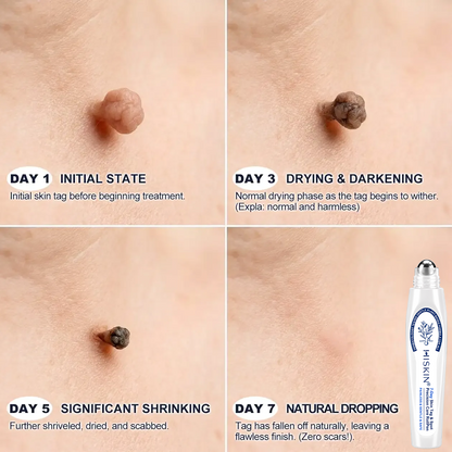 ❤️𝐇𝐈𝐒𝐊𝐈𝐍®👩‍⚕️ 𝟕-𝐃𝒂𝘆 𝐒𝗸𝐢𝐧 𝐓𝒂𝗴 & 𝐒𝐩𝙤𝐭 𝐄𝐫𝒂𝐬𝙚𝐫 Sans douleur & Scar-Free Advanced Imperfection Removal Rollerball Pen (副本)
