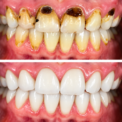🧑‍⚕️🦷❄️Solaroza® Gum Revive periodontal repair gel